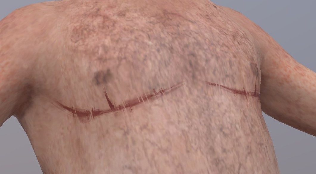 Top Surgery Scars