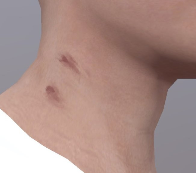 Healed Vampire Bites